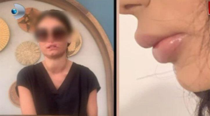 Dudaklarını yaptırmak istedi, kabusu yaşadı! Su bile içemiyor…
