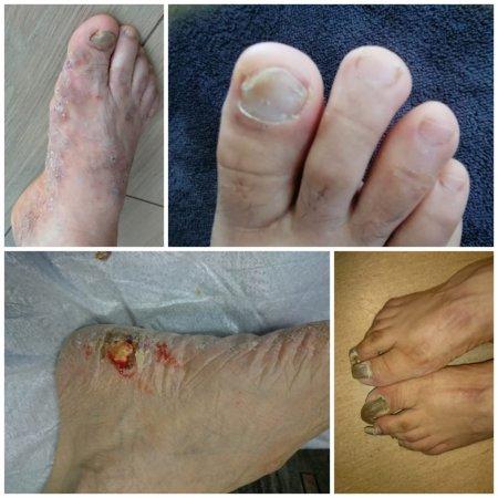 Tinea pedis yani ayak mantarı