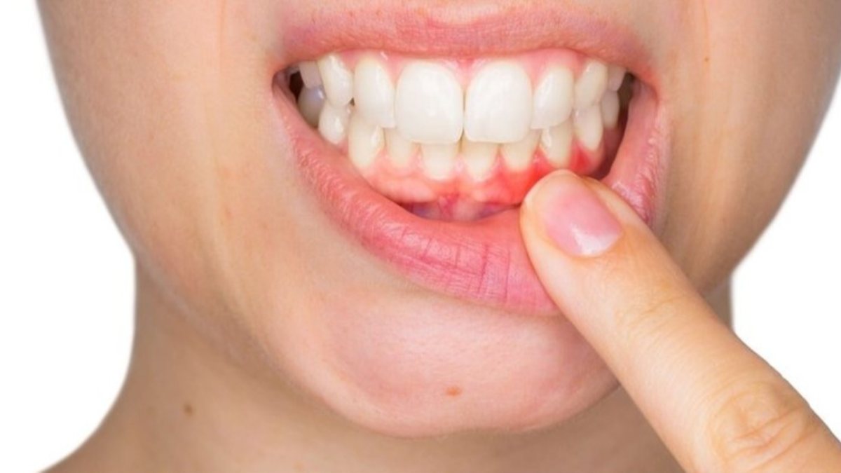 Diş eti iltihabına âlâ gelen 3 mucizevi teklif