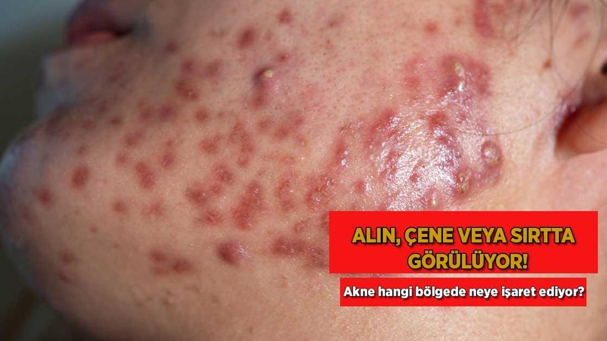 Alın, çene veya sırtta görülüyor! Akne hangi bölgede neye işaret ediyor?
