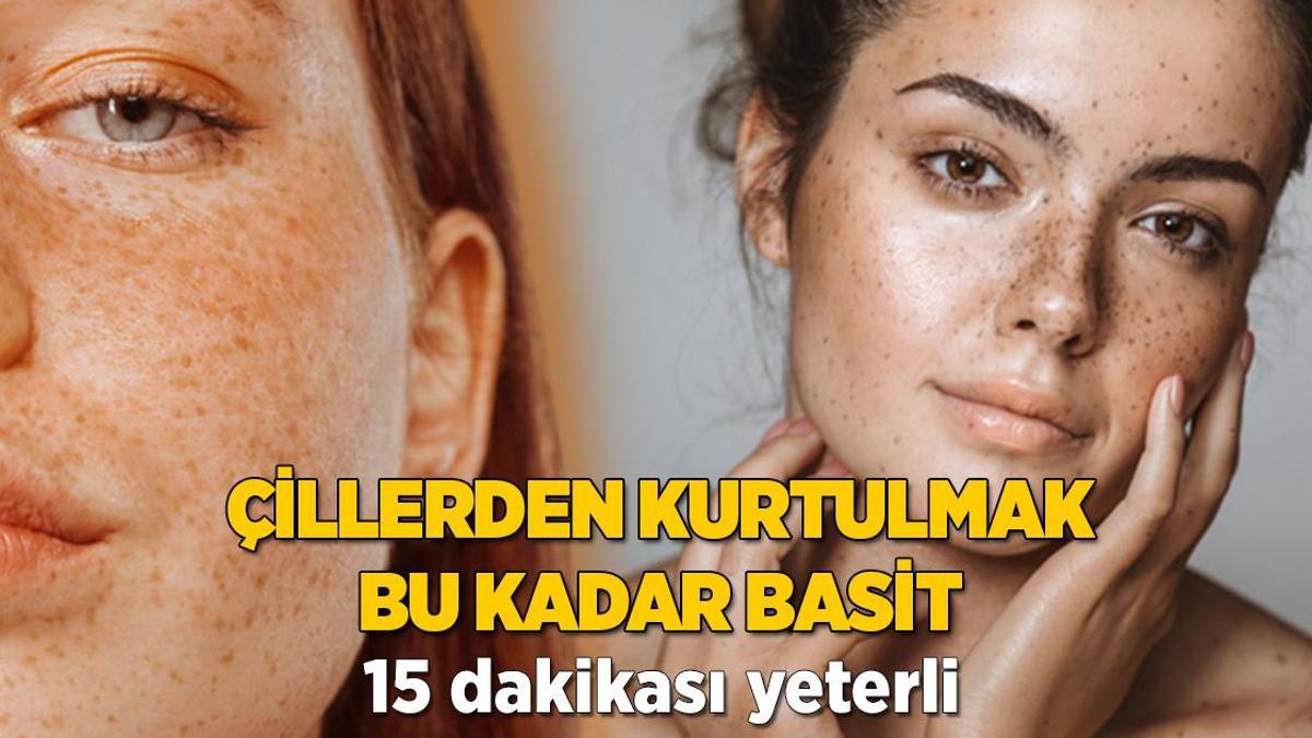 Çillerden saniyeler içinde kurtaran karışım! Seruma, kreme hiç gerek yokmuş